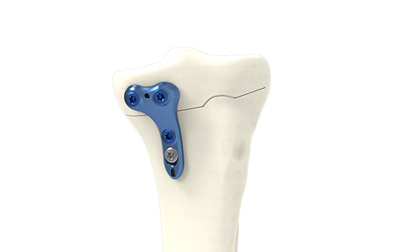 Fermeture tibial Medial Taille 1 GAUCHE Gallery