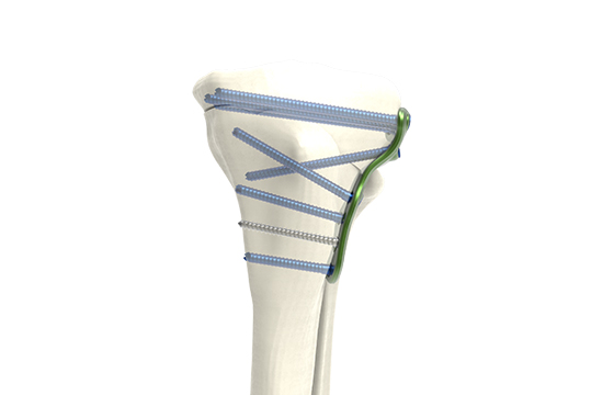 Fermeture lateral coupe oblique avec vis VUE PROFILE