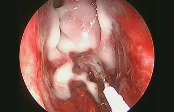 Vivostat Autologous Fibrin