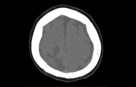 Cranial Loop Flap Fixation