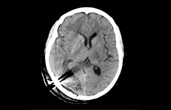 Cranial Loop Flap Fixation