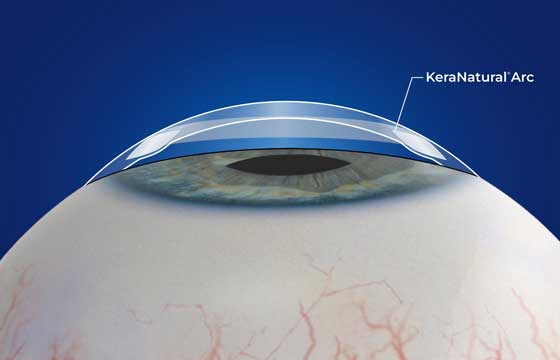 KN Arc Cross Section