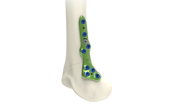 Montage sur os JBTxM1D