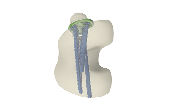 Montage sur os JBTxM1D vis