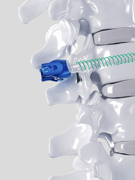 Ennovate® Thoracolumbar & Sacropelvic Screw